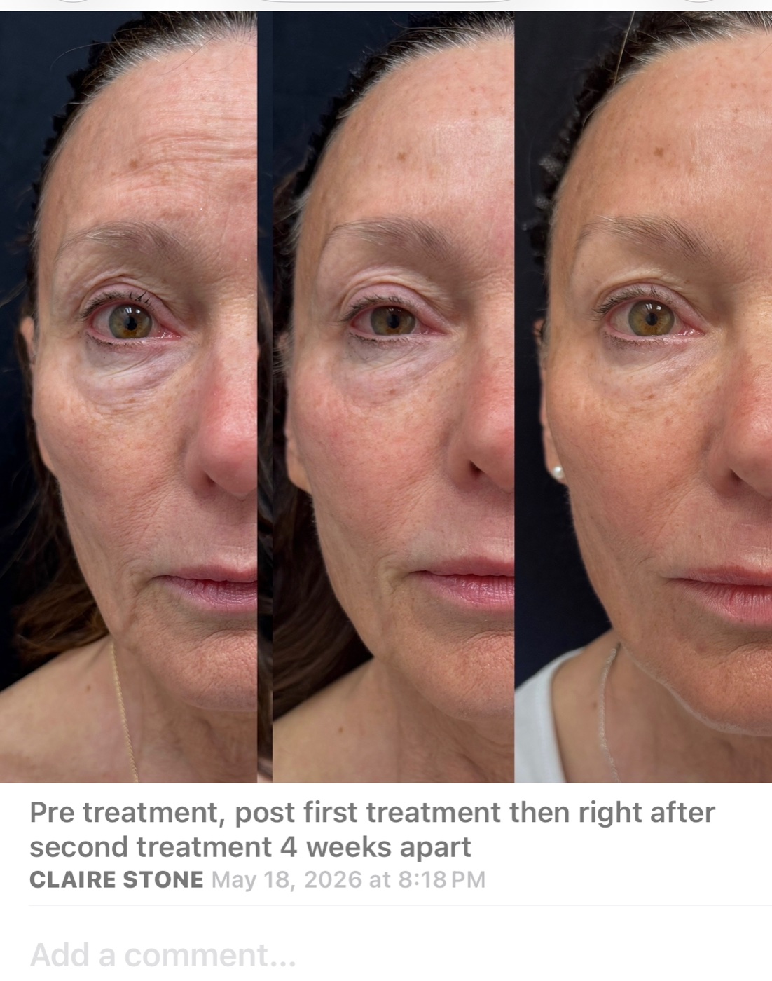 Across a course before and after at Glow By Laser
