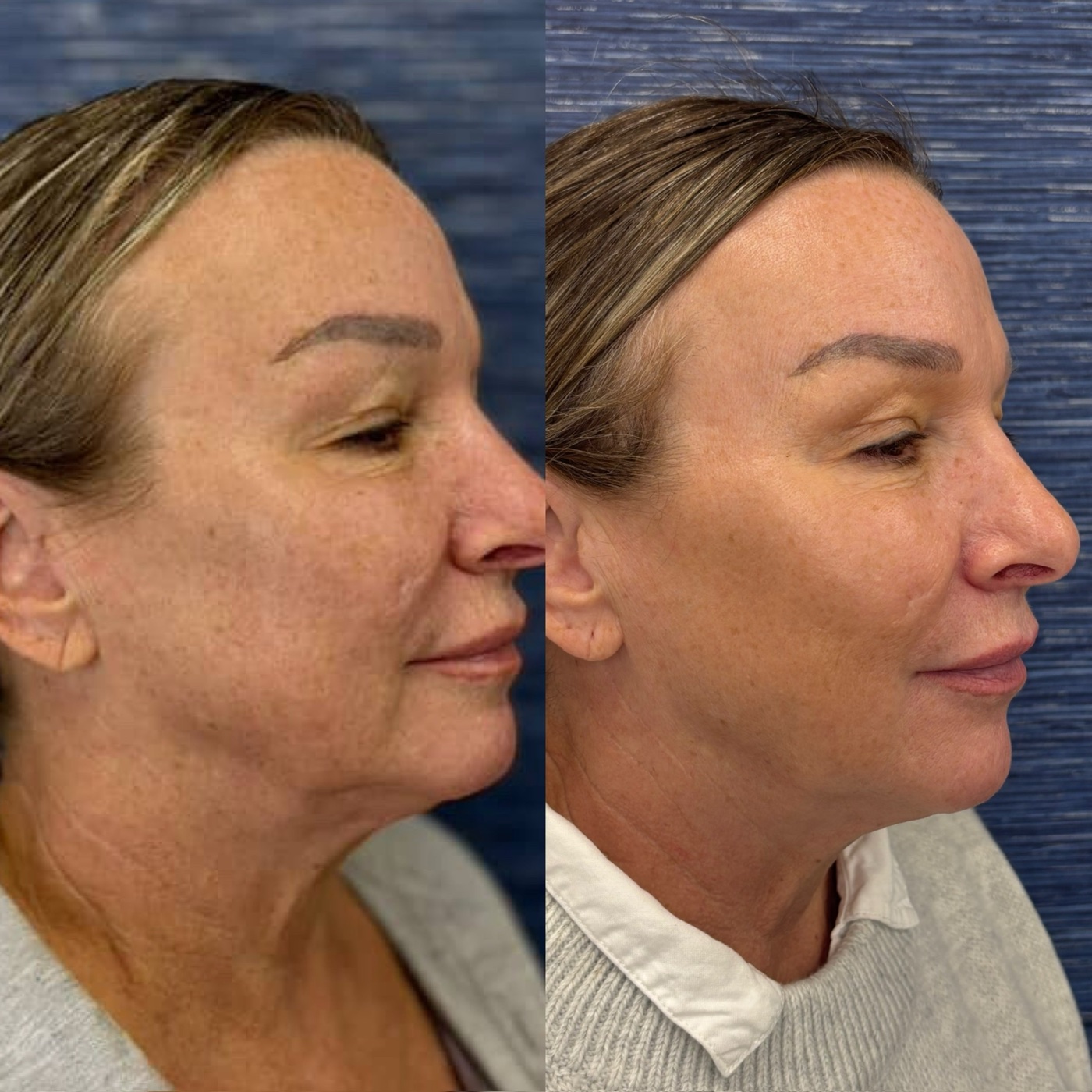 Tone & texture before and after at Glow By Laser