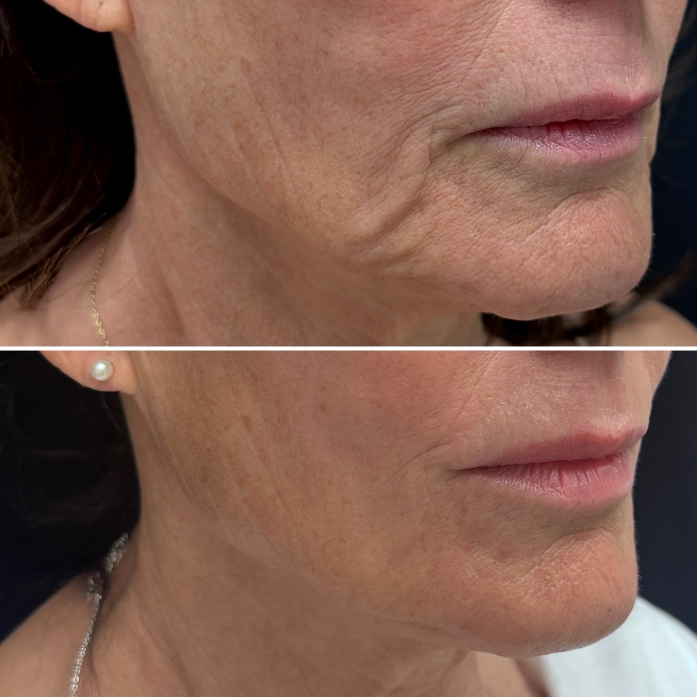 Jawline, in profile before and after at Glow By Laser