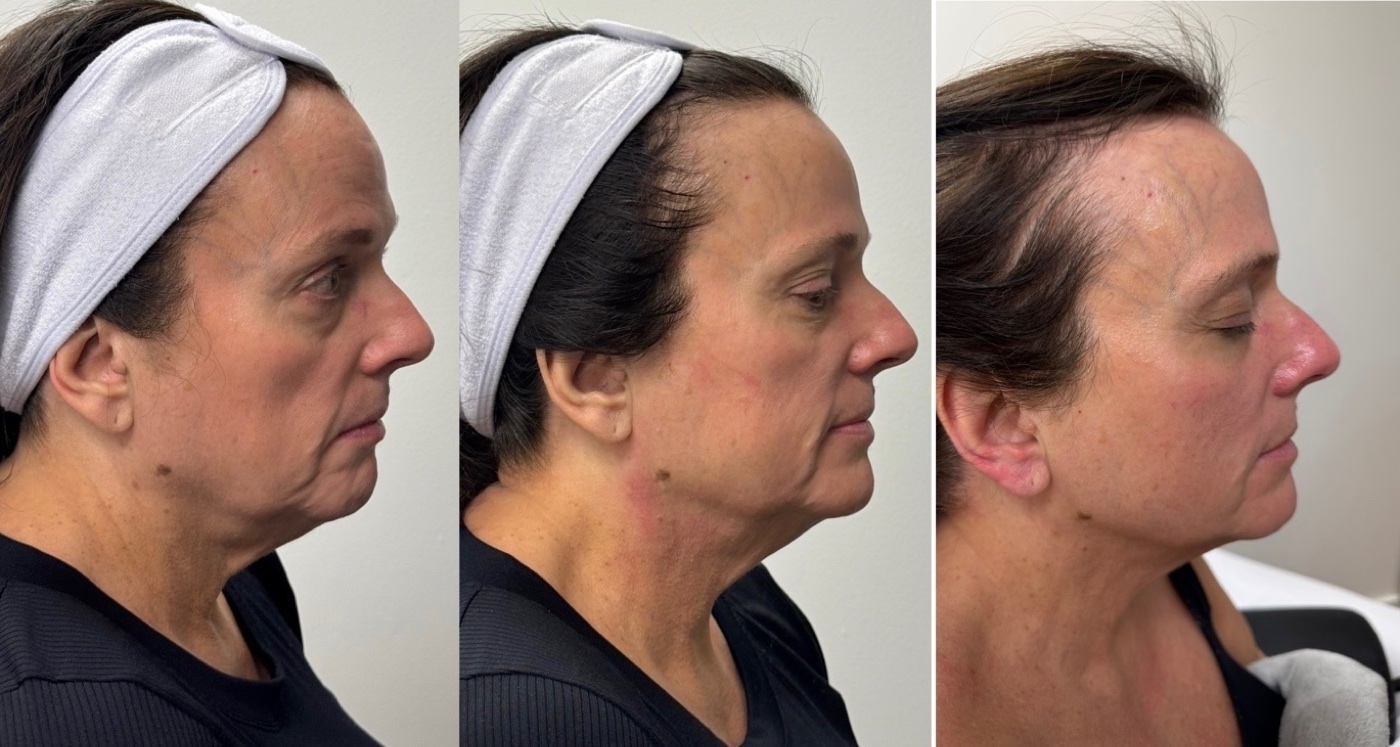 Jaw & neck contour before and after at Glow By Laser