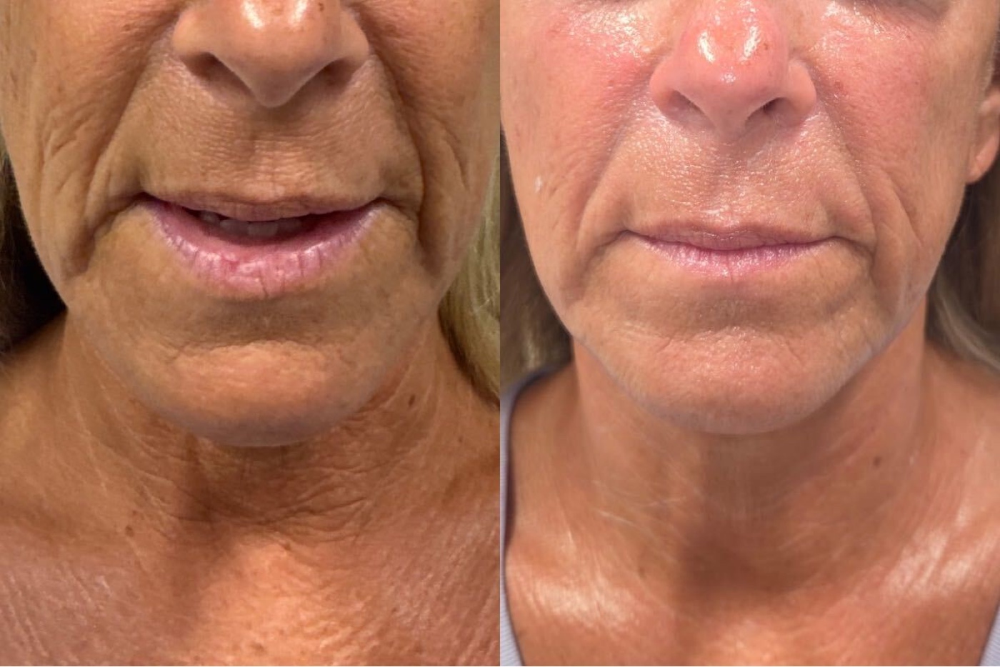 Lower face & jawline before and after at Glow By Laser