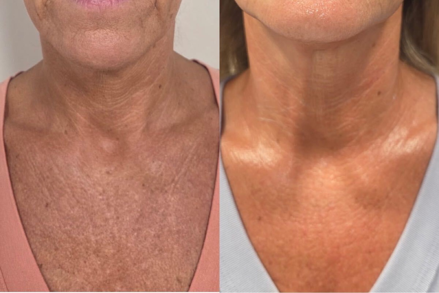 Neck & décolletage before and after at Glow By Laser