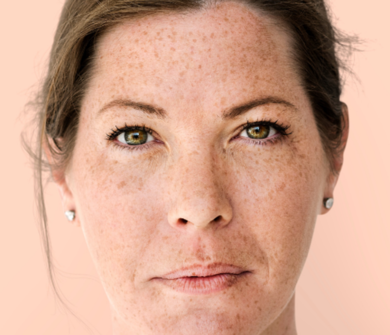 Melasma Treatment